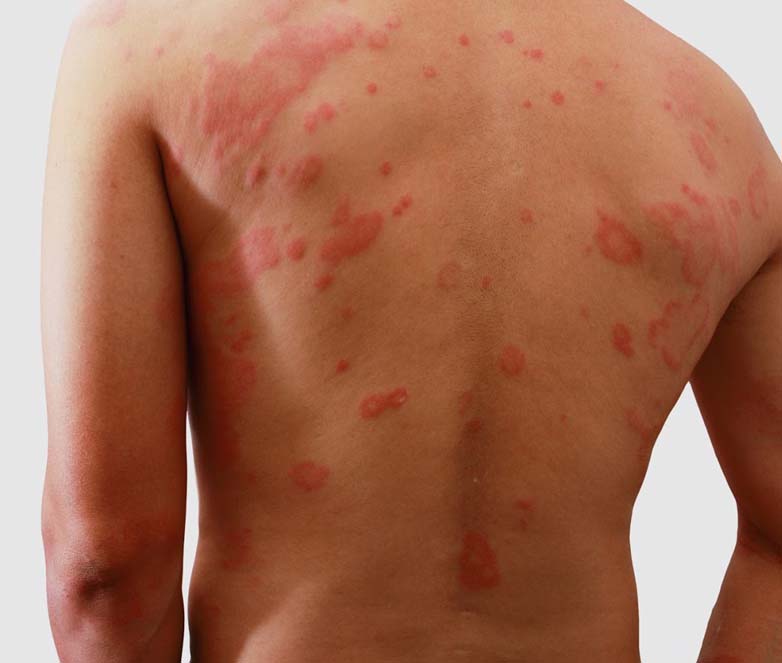 Pictures Of Skin Rashes Different Type Of Skin Rashes Healthy