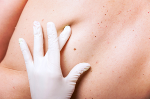 Dermatologist inspecting mole on someones back Manchester
