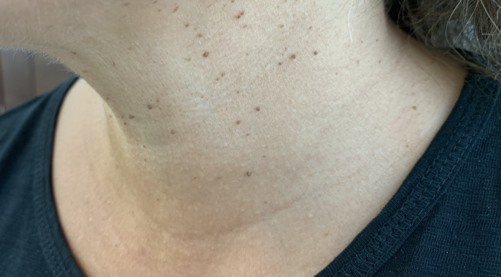 Before SKIN TAG REMOVAL left neck