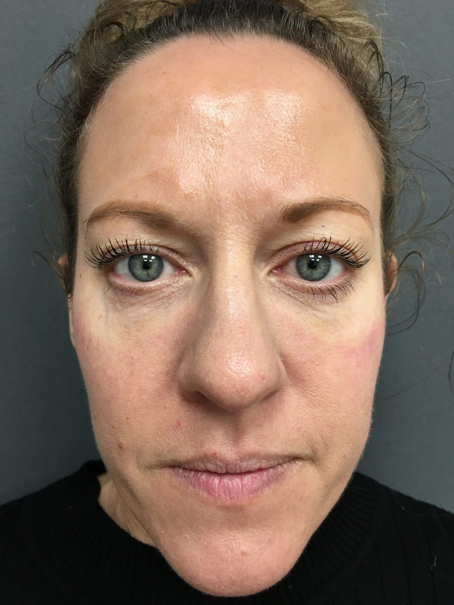 Dermal Fillers Manchester, Lancashire & Cheshire | Dr Nicole Dermatology