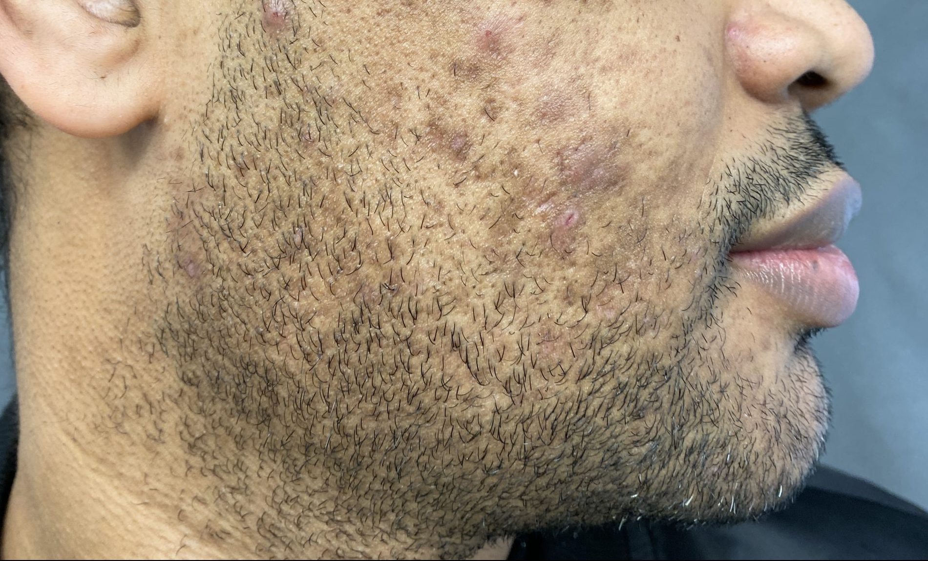 Acne Scar and Rosacea Treatment Manchester, Cheshire & Lancashire Dr